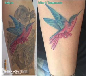 Laser Tattoo Removal Results at Think Again Laser Clinic - Best tattoo removal sydney