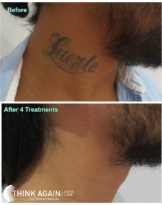 neck tattoo removal after four sessions