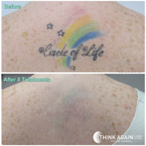 before-and-after-8-laser-tattoo-removal-treatments-on-colourful-rainbow-tattoo-upper-back