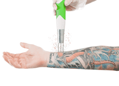 Lets Know What Makes A “Tattoo Removal Specialist”?
