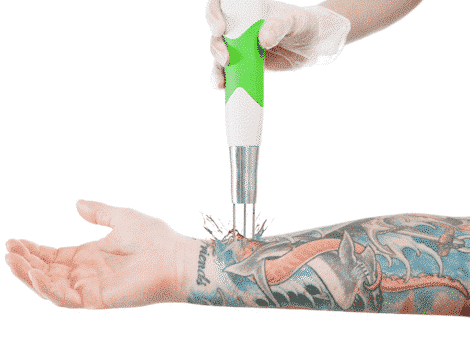 Water And Laser Tattoo Removal