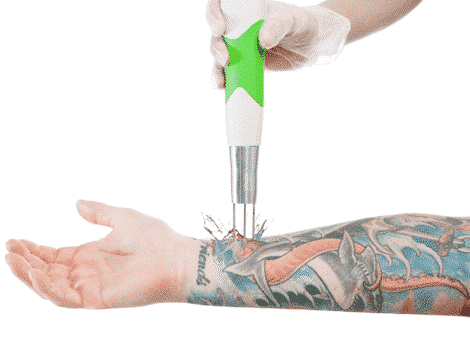 Laser Tattoo Removal Glenfield, Auckland | Beautilase