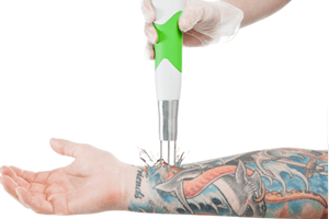 Begin Your Tattoo Removal Treatment Now – Pay Later