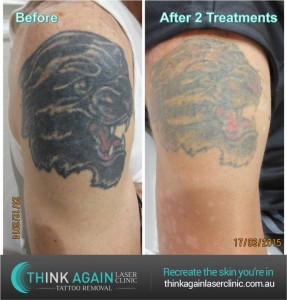 How many sessions of laser tattoo removal will I need? -