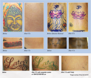 Tattoo Removal Sydney