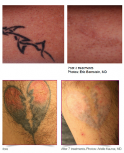 Tattoo Removal Sydney