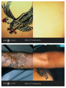 Tattoo Removal Sydney