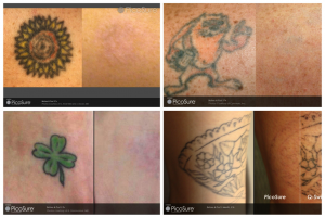 Tattoo Removal Sydney