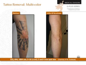 Tattoo Removal Sydney