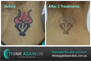 After 3 treatments at Think Again Laser Clinic with the Quanta Q-Plus C