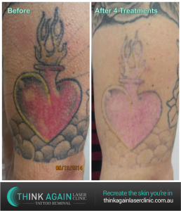 After 4 treatments at Think Again Laser Clinic with the Quanta Q-Plus C