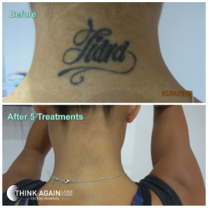 Before and After - By Think Again Laser Clinic