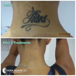 Tattoos Removed In 5 6 7 8 Treatments Guaranteed Think Again Tattoo Removal Laser Clinic