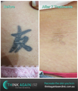 Tattoos Removed In 5 6 7 8 Treatments Guaranteed Think Again Tattoo Removal Laser Clinic