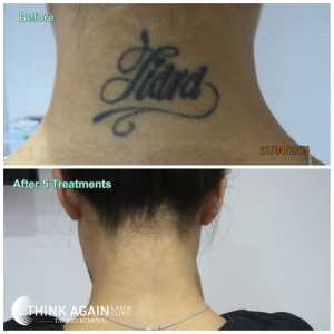 Laser Tattoo Removal