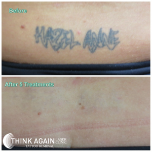Laser Tattoo Removal Results at Think Again Laser Clinic; Best tattoo removal sydney