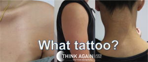 Laser Tattoo Removal Results at Think Again Laser Clinic - Best tattoo removal sydney