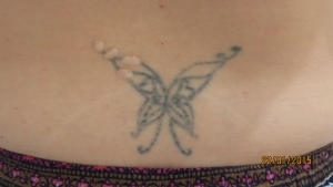 Before and after non laser tattoo removal sydney