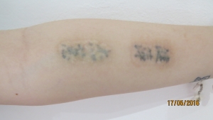 Before and after non laser tattoo removal sydney
