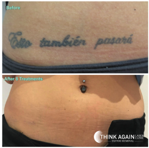 Laser Tattoo Removal Results - 8 Treatments. Tattoo Removal Guarantee. Best Tattoo Removal Sydney.