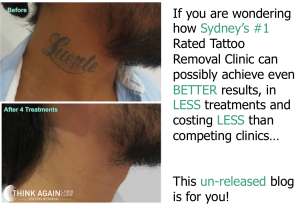 Laser Tattoo Removal Results - 4 Treatments. Tattoo Removal Guarantee. Best Tattoo Removal Sydney.