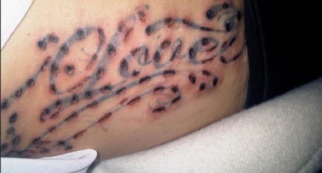 Tattoo Removal Damaged Skin