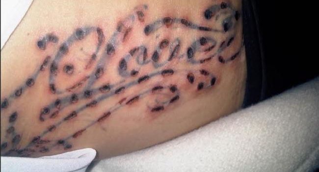 Before  After Tattoo Removal Results  Laser Tattoo Removal Specialists