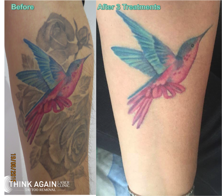 Tattoo Removal Vancouver Cost