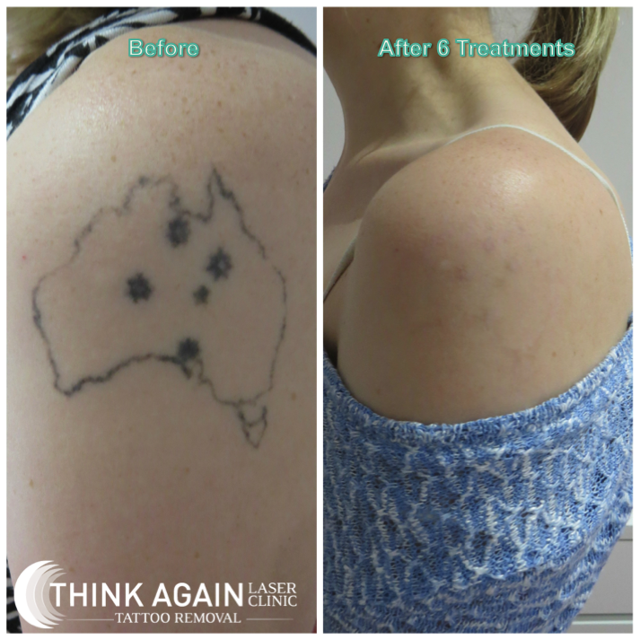 best laser tattoo removal clinic sydney cbd think again laser clinic best laser tattoo removal clinic sydney cbd think again laser clinic