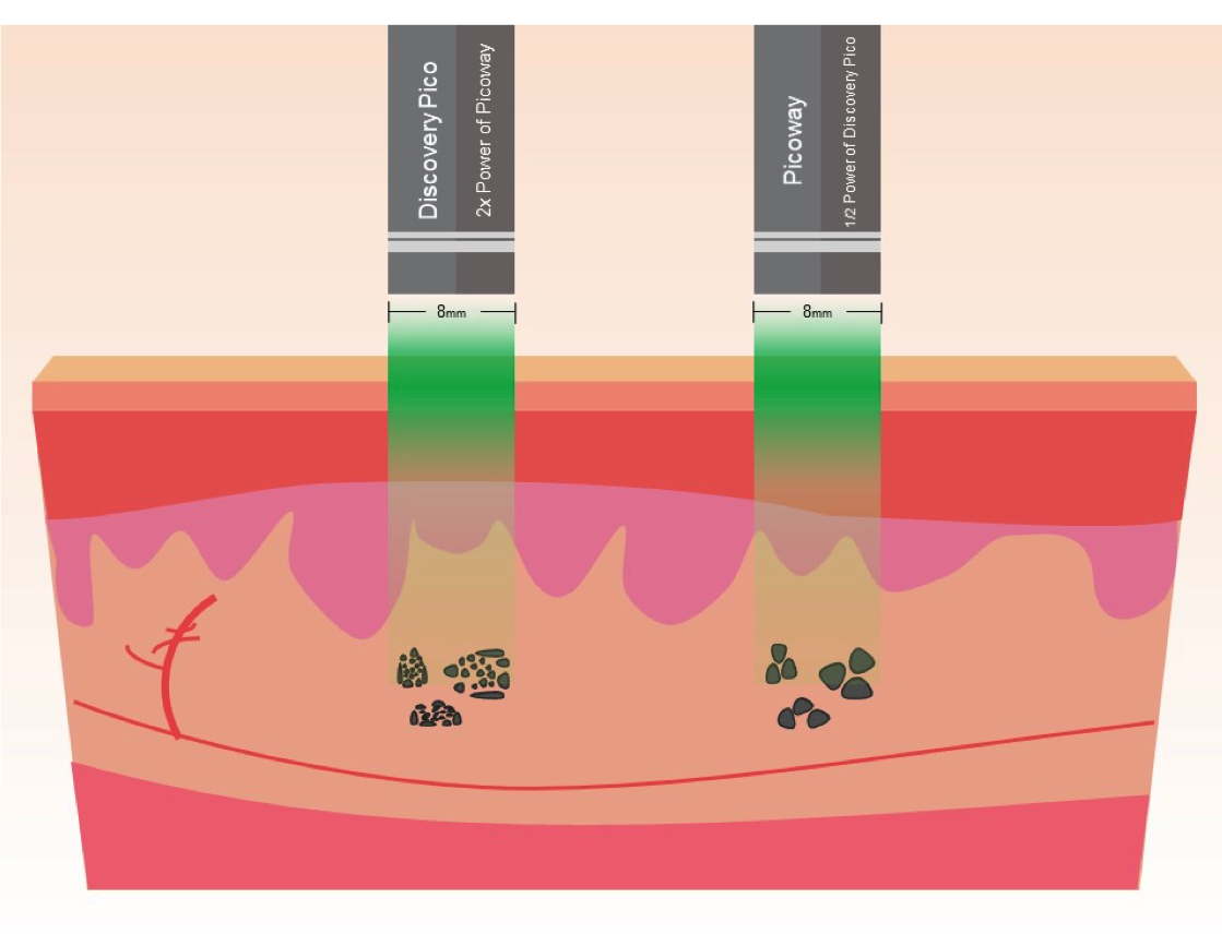 Quanta Discovery Pico Plus efficiency in comparison to PicoWay Laser Tattoo Removal System