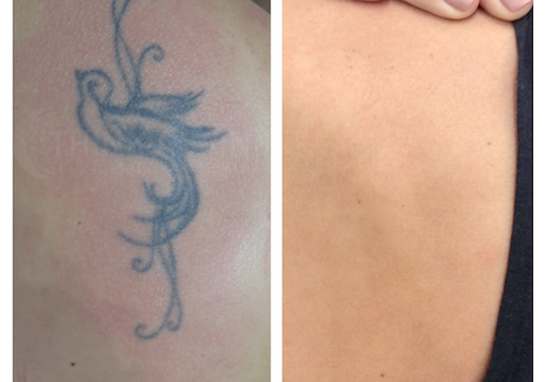 Easy-tattoo-removal-with-Sydney-Tattoo-removal