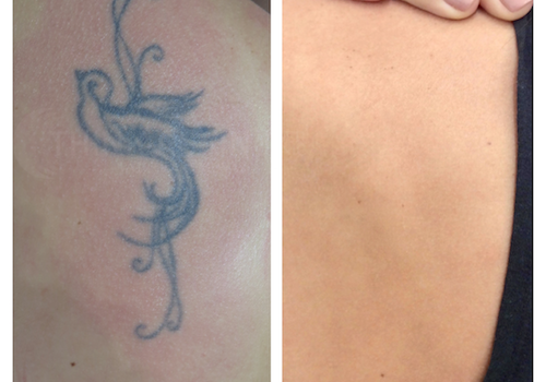 Tattoo Removal — Silhouette