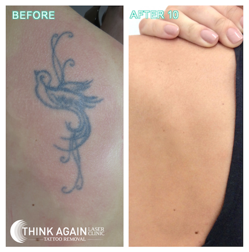 easy-tattoo-removal-with-Sydney-Tattoo-removal