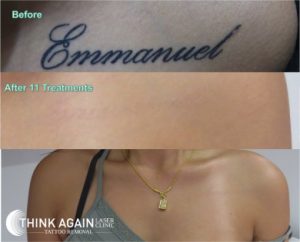 tattoo removal of name