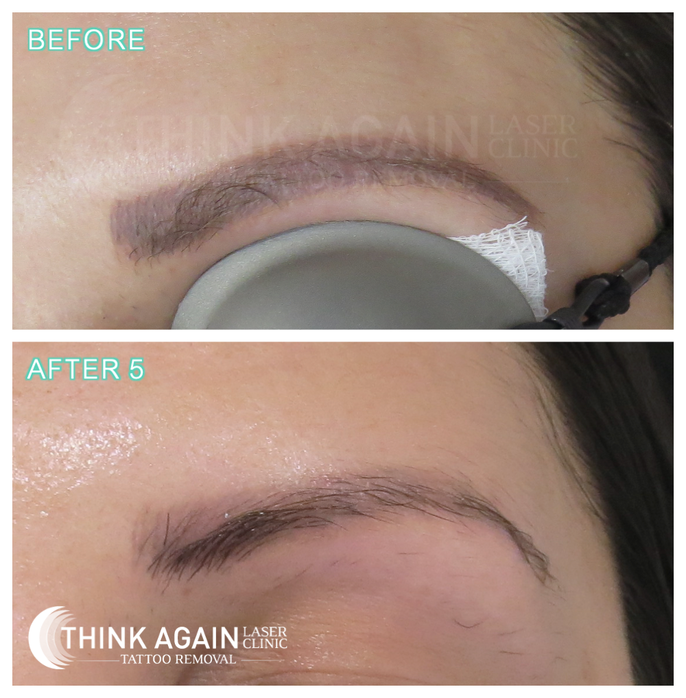 before and after 5 laser tattoo removal treatments on cosmetic eyebrow tattoo at Think Again Laser Clinic Sydney.
