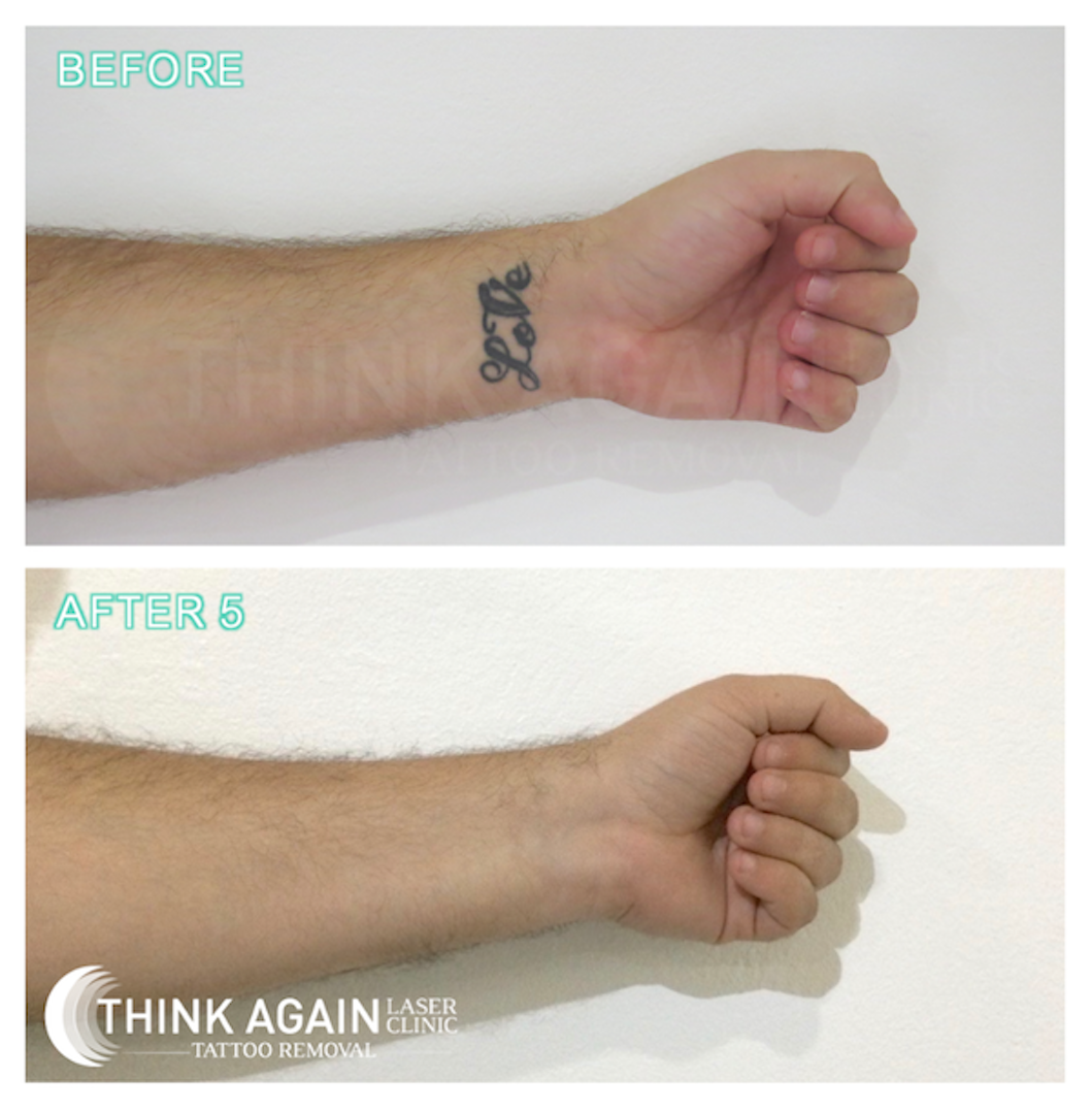 Tattoo Removal Results in Sydney - Before and After Pics