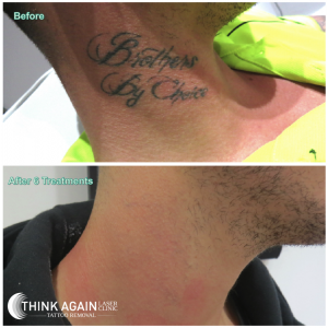 before and after 6 laser tattoo removal treatments neck tattoo at Think Again Laser Clinic Sydney