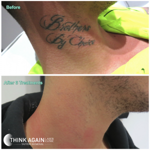 Tattoo Removal Before and After Photos  Goodbye Tattoos