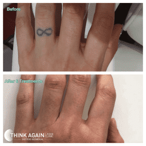 65 Best Tattoo Removal Before and After ideas  laser tattoo removal tattoo  removal laser tattoo