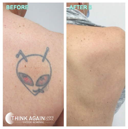 Tattoo Removal Results in Sydney Before and After Pics