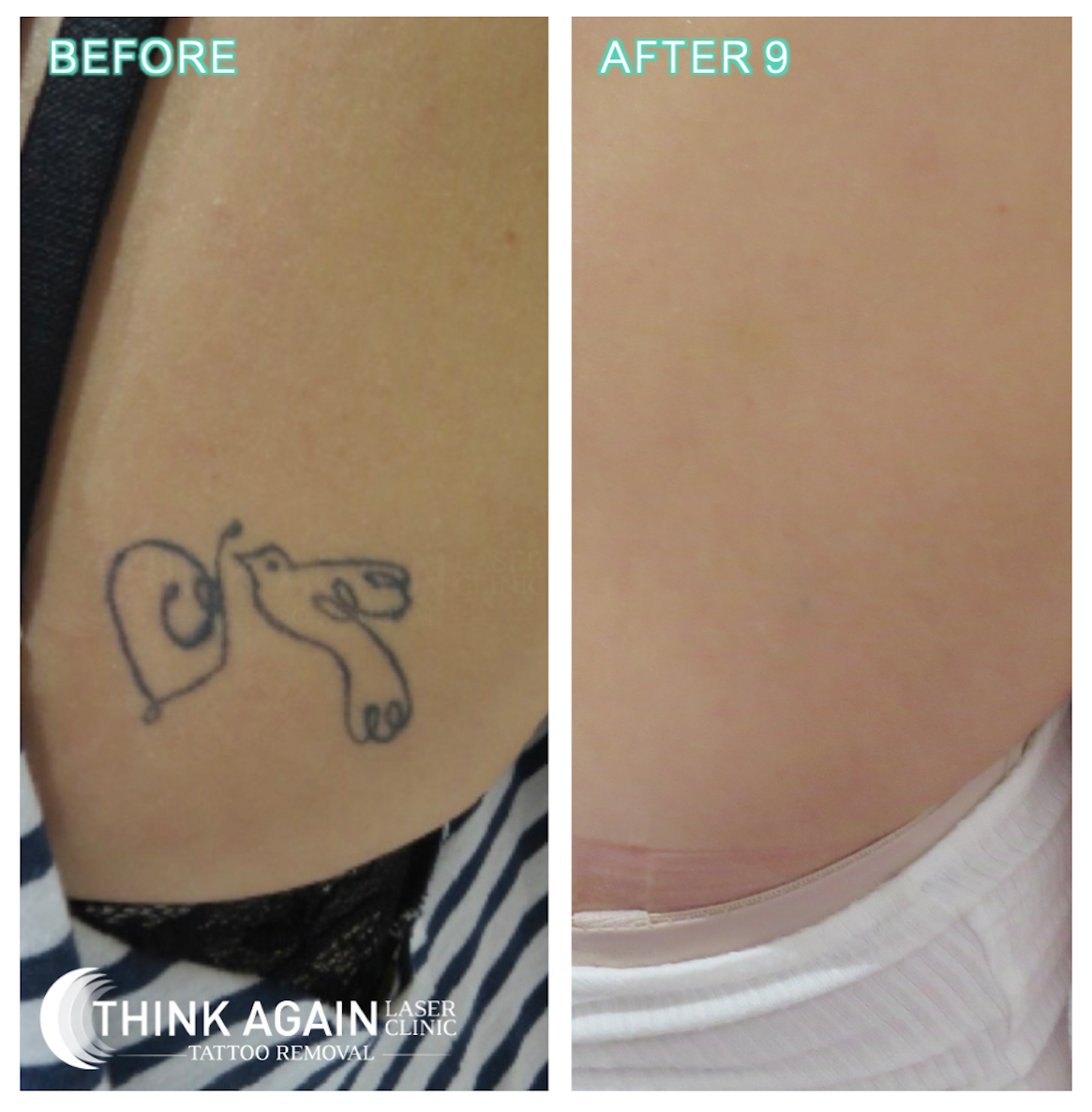 Inkfree MD  𝐁𝐞𝐟𝐨𝐫𝐞 𝐚𝐧𝐝 𝐀𝐟𝐭𝐞𝐫 Another example of our  amazingly fast tattoo removal results with our PicoPlus laser    The 3rd and final treatment was just to clean everything up