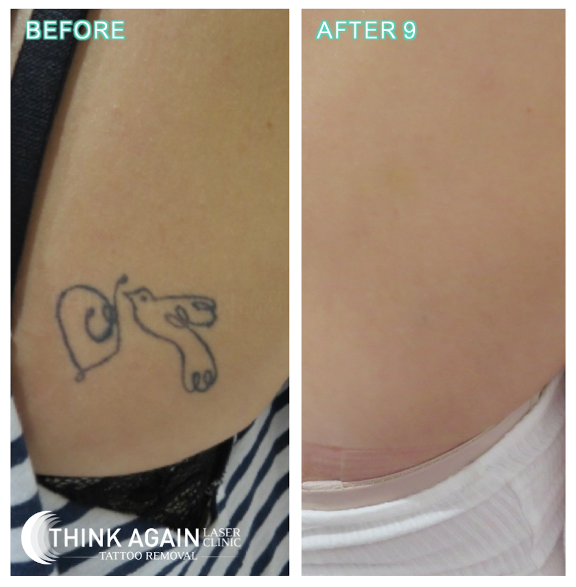 Tattoo Removal Gallery - Dr. Jeffrey Yager