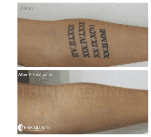 before and after 9 laser tattoo removal treatments on black roman numerals forearm tattoo at Think Again Laser Clinic Sydney