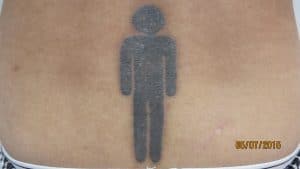 Cynosure PicoSure laser tattoo removal results, lower back black tattoo