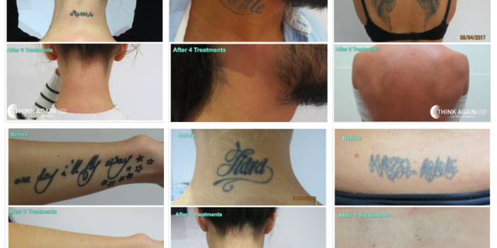 Laser Tattoo Removal Intake, Consent, and Aftercare Form | 75 Pack | 8.5 x  11