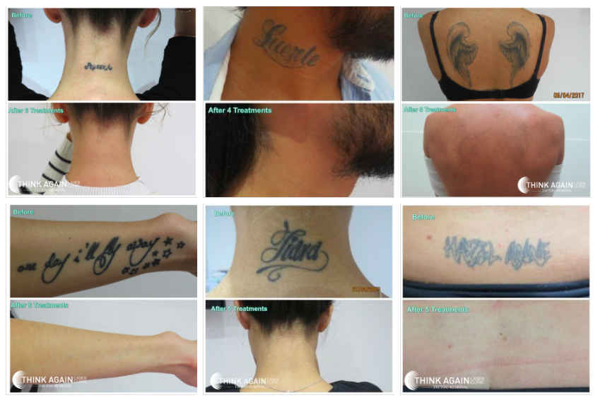 Best sydney laser tattoo removal results at Think Again Laser Clinic Sydney