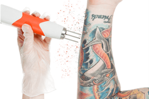 How Many Laser Tattoo Removal Treatments Will I Need?