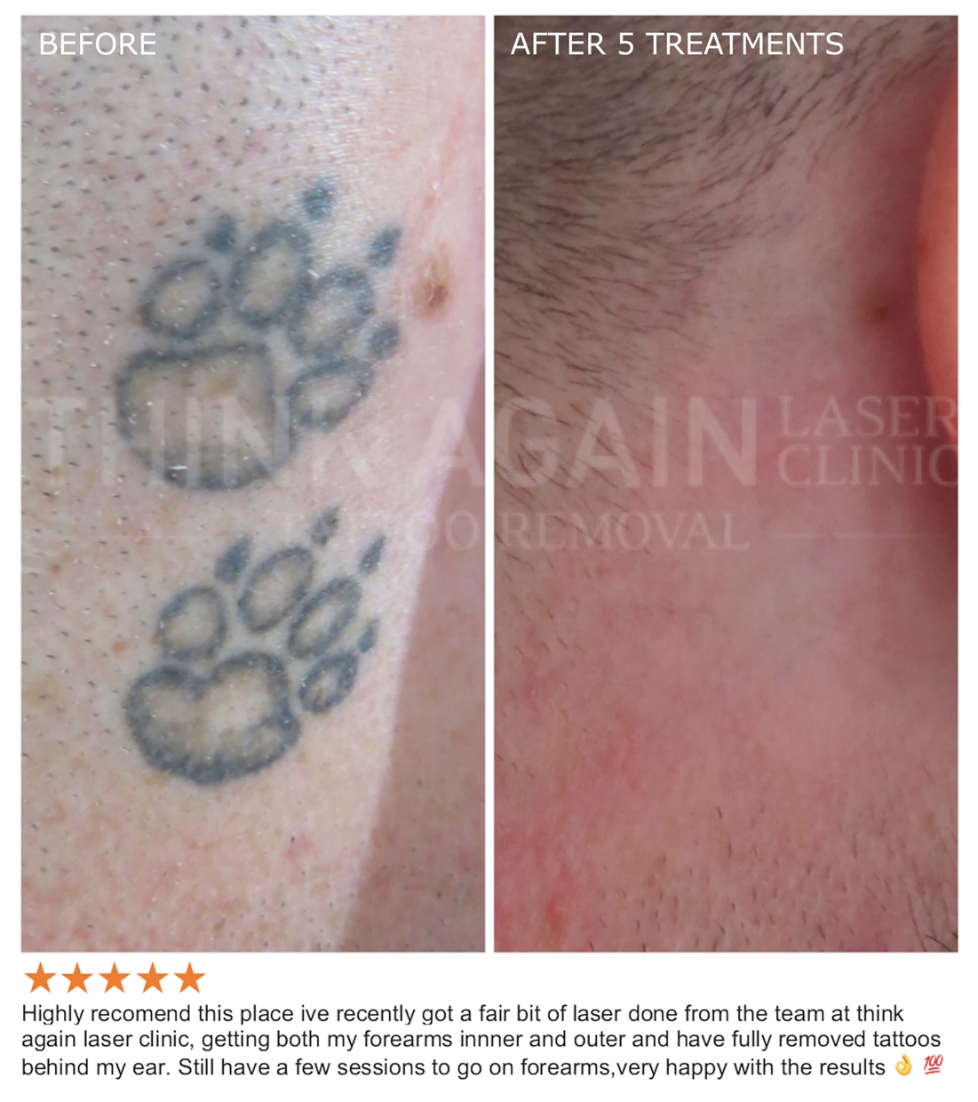 Afterpay, Lazer Erazer Tattoo Removal