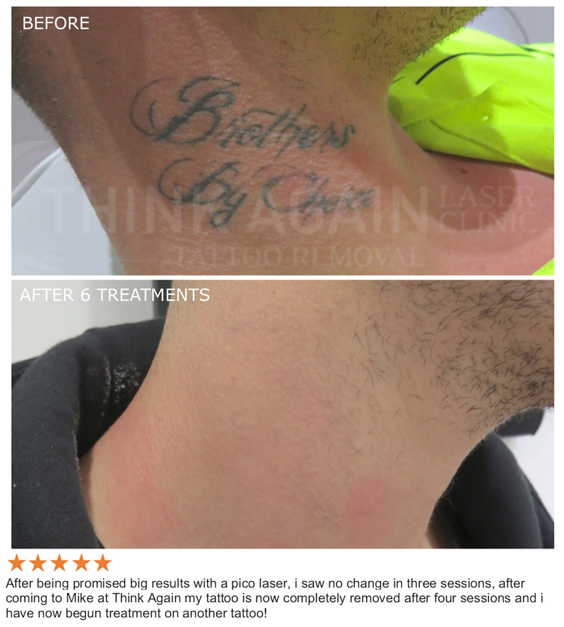 Before  After Images of Laser Tattoo Removal treatment  Orchid Cosmo laser