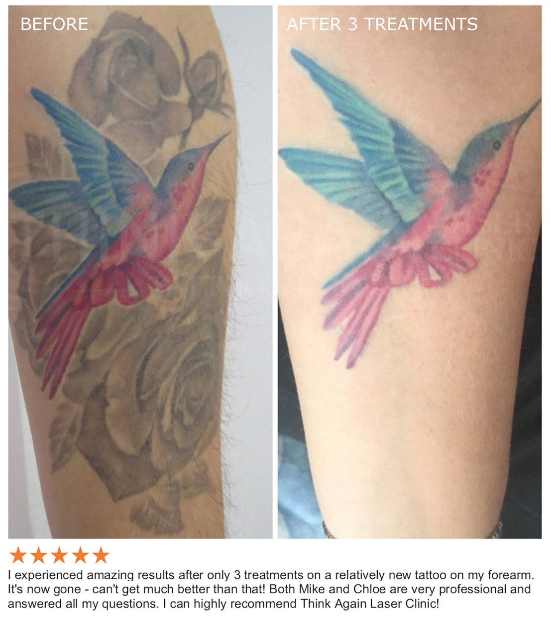 Tattoo Removal TopDocscom